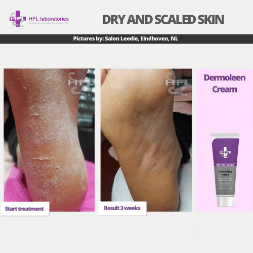 Dermoleen_cream_-_HFL_Laboratories