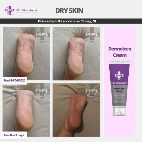 Dermoleen_cream_-_HFL_Laboratories_1