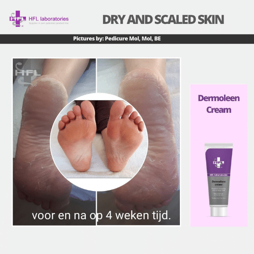 Dermoleen_cream_-_HFL_Laboratories_2