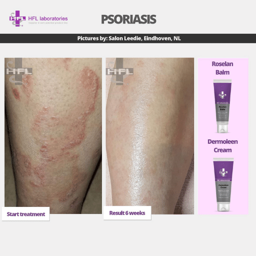 Roselan_Balm_Dermoleen_creme-_HFL_Laboratories