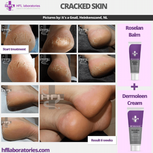 Roselan_Balm_Dermoleen_creme-_HFL_Laboratories_2