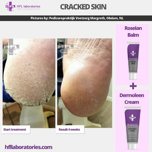 Roselan_Balm_Dermoleen_creme-_HFL_Laboratories_4