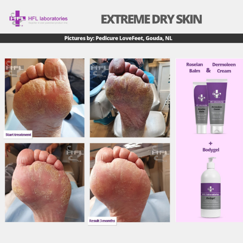 Roselan_Balm_Dermoleen_creme-_HFL_Laboratories_5