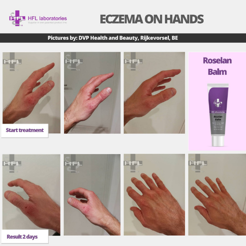 Roselan_Balm_Dermoleen_creme-_HFL_Laboratories_6