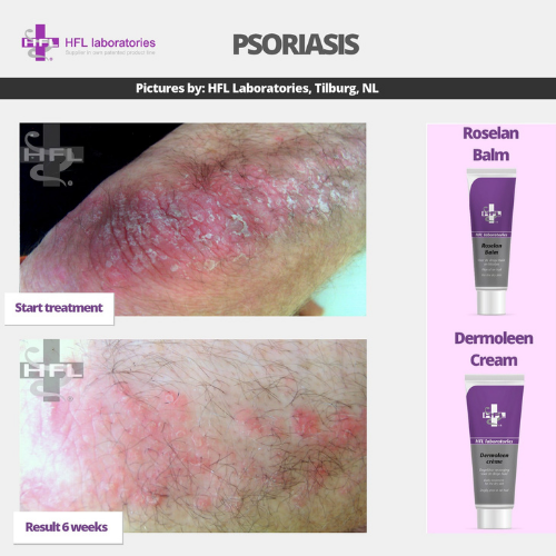 Roselan_Balm_Dermoleen_creme-_HFL_Laboratories_7