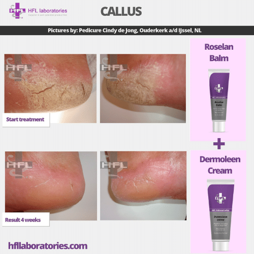 Roselan_Balm_Dermoleen_creme-_HFL_Laboratories_8