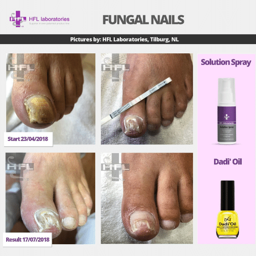 Solution_spray-_HFL_Laboratories_-_Resultaten_foto5_1