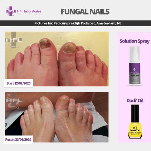 Solution_spray-_HFL_Laboratories_-_Resultaten_foto6_1