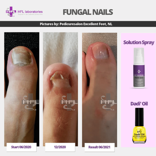 Solution_spray-_HFL_Laboratories_-_Resultaten_foto8