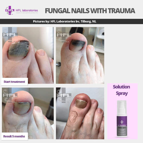 Solution_spray-_HFL_Laboratories_-_Resultaten_foto_3