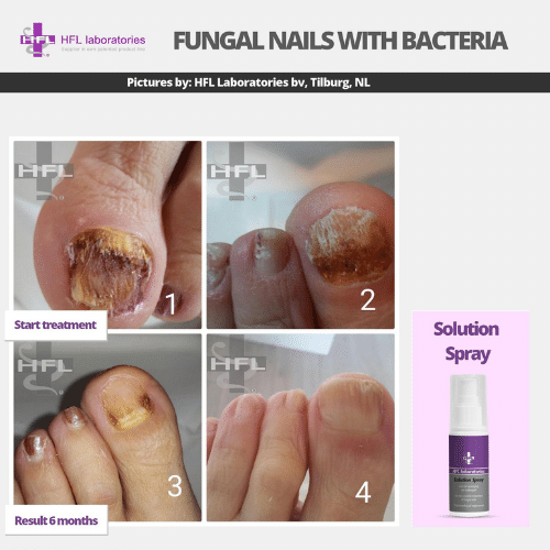 Solution_spray-_HFL_Laboratories_-_Resultaten_foto_4