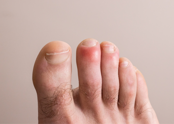 Wintertenen_symptomen